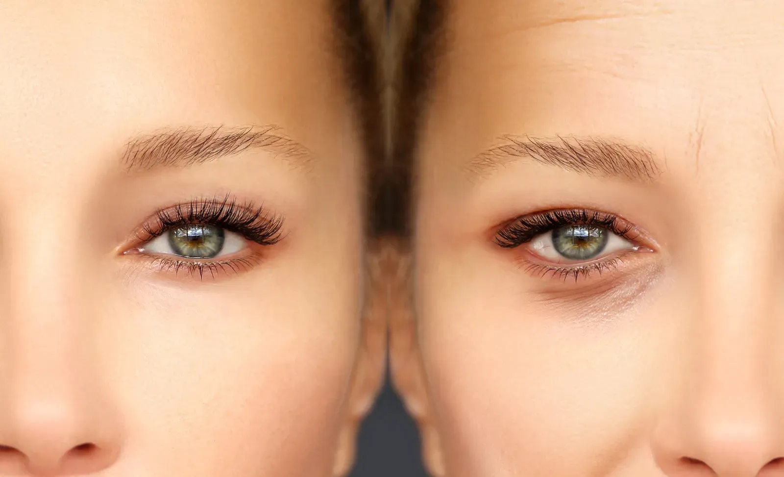 Augenring-Behandlung mit Hyaluron