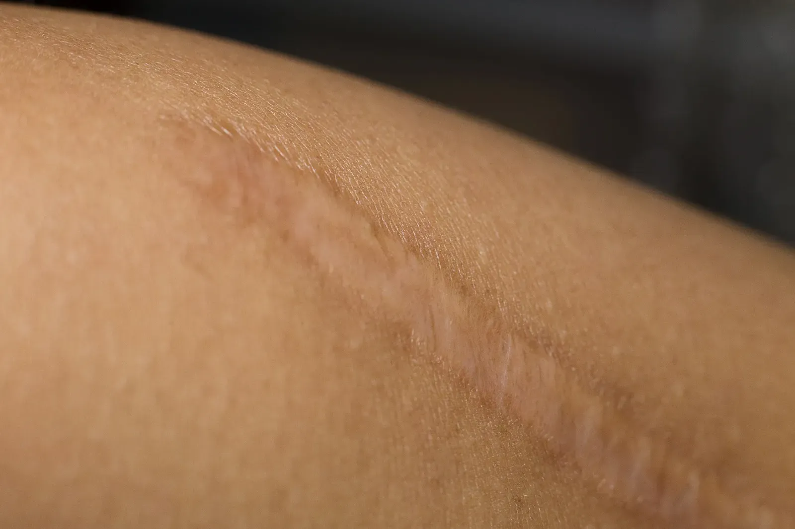 Narbenbehandlung Vampire Lift