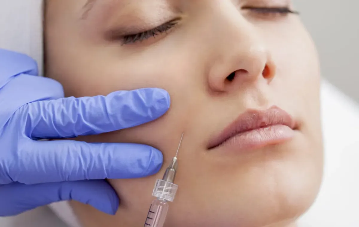 Nasolabialfalte-Unterspritzung